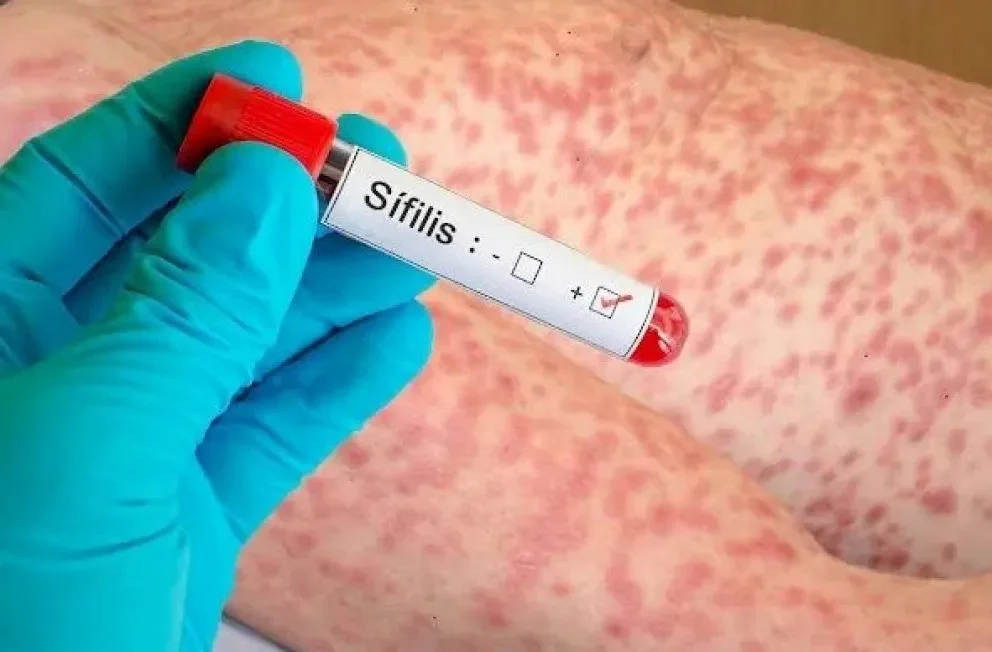 Sifilis